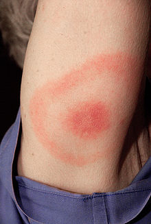 Lyme disease rash
